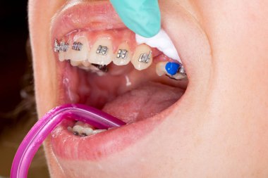 Genç kadının ağzına resmi oluşturan kapatın. Diş diş teli - tedavi