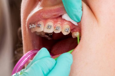 Genç kadının ağzına resmi oluşturan kapatın. Diş diş teli - tedavi