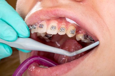 Genç kadının ağzına resmi oluşturan kapatın. Diş diş teli - tedavi