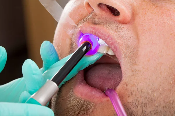 Leczenie Stomatologiczne Lampa Polimeryzacji Jamy Ustnej Pacjent Bliska — Zdjęcie stockowe