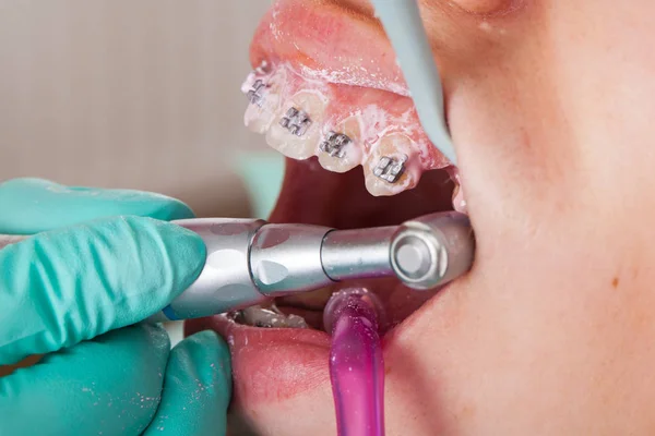 Genç Kadının Ağzına Resmi Oluşturan Kapatın Diş Diş Teli Tedavi — Stok fotoğraf