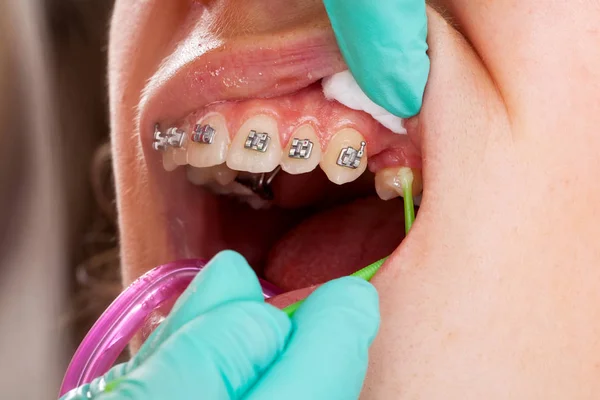 Imagen Cerca Boca Una Joven Hembra Frenos Dentales Tratamiento — Foto de Stock
