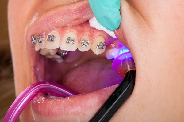 Genç kadının ağzına resmi oluşturan kapatın. Diş diş teli - tedavi