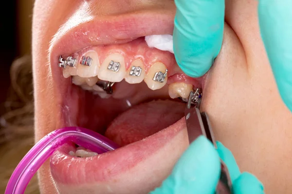 Imagen Cerca Boca Una Joven Hembra Frenos Dentales Tratamiento — Foto de Stock