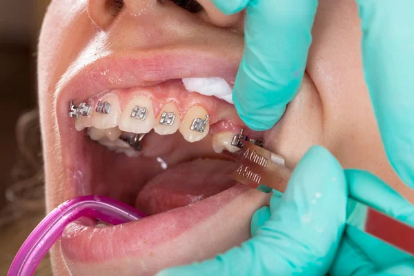 Nahaufnahme Des Mundes Der Jungen Frau Zahnspangen Behandlung — Stockfoto