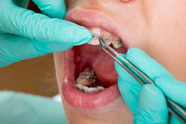 Imagen Cerca Boca Una Joven Hembra Frenos Dentales Tratamiento — Foto de Stock