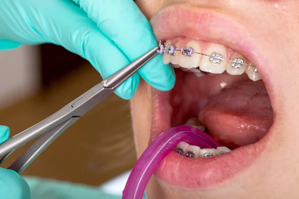 Imagen Cerca Boca Una Joven Hembra Frenos Dentales Tratamiento —  Fotos de Stock