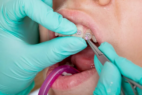 Zavřete Obrázek Mladých Úst Zubní Rovnátka Léčba — Stock fotografie