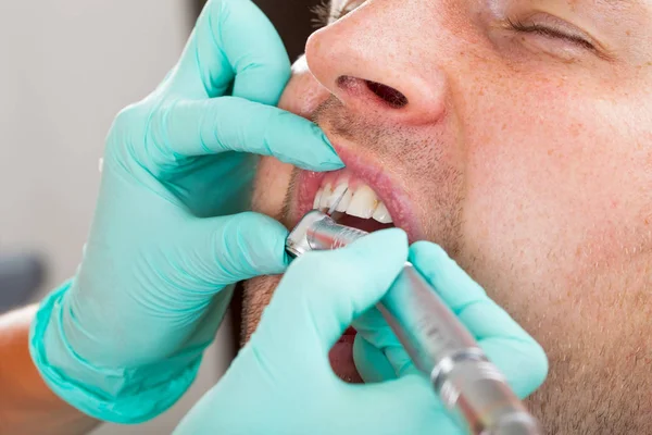 Close Picture Dentist Using Drill Dental Treatment Male Patient Oral — Stock Photo, Image