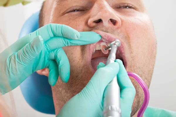 歯科医のドリルを用いた歯科治療 男性の患者さんの口腔内の写真を閉じる — ストック写真
