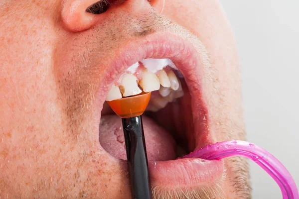 Tratamiento Dental Con Lámpara Polimerización Cavidad Oral Paciente Masculino Cerca — Foto de Stock