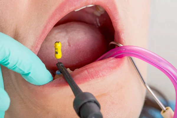 Nahaufnahme Des Zahnärztlichen Eingriffs Patientin — Stockfoto