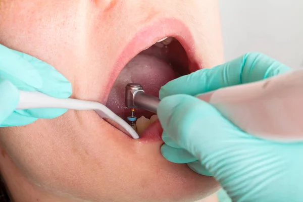 Imagem Perto Procedimento Dentário Paciente Feminina — Fotografia de Stock