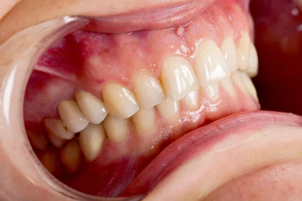 Imagen Cerca Del Retractor Mejillas Boca Del Paciente Tratamiento Dental — Foto de Stock