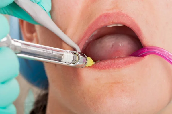 Photo Rapprochée Une Patiente Cabinet Dentiste Recevant Une Anesthésie Dentaire — Photo