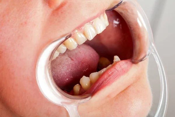 Imagen Cerca Del Retractor Mejillas Boca Del Paciente Tratamiento Dental — Foto de Stock