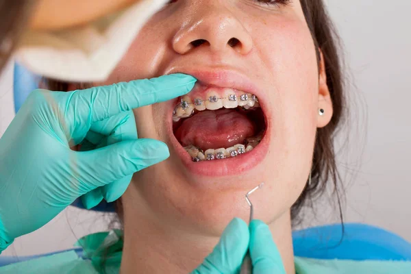 Foto Ravvicinata Una Giovane Donna Con Apparecchio Dentale Presso Studio — Foto Stock