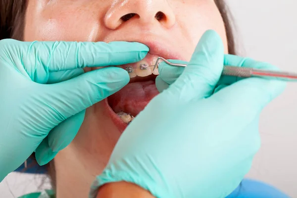 Foto Ravvicinata Una Giovane Donna Con Apparecchio Dentale Presso Studio — Foto Stock