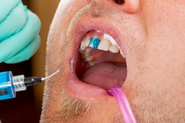 Adam açık bir diş dolgu elde