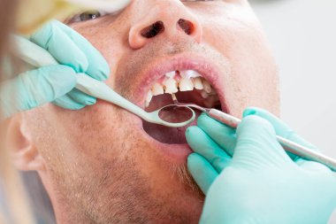 Adam açık bir diş dolgu elde