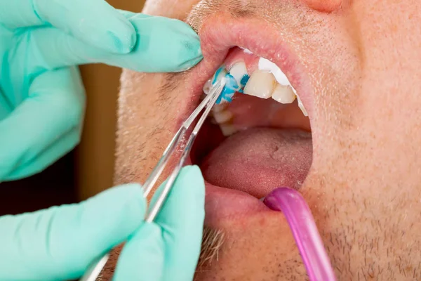 Uomo Ottenere Riempimento Dentale Anteriore — Foto Stock