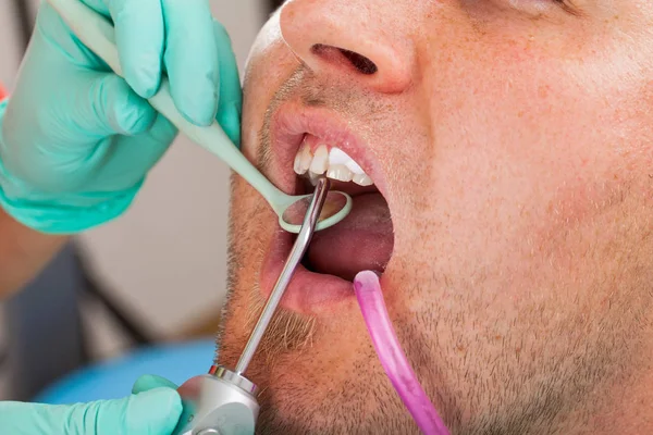 Adam açık bir diş dolgu elde