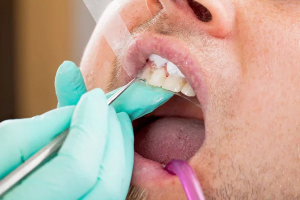 Homem Recebendo Recheio Dental Frontal — Fotografia de Stock