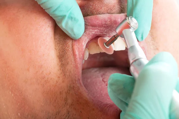 Nahaufnahme Eines Zahnarztes Mit Bohrmaschine Zur Zahnbehandlung Mundhöhle Des Männlichen — Stockfoto
