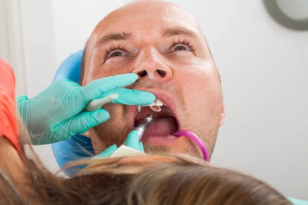 Nahaufnahme Eines Zahnarztes Mit Bohrmaschine Zur Zahnbehandlung Mundhöhle Des Männlichen — Stockfoto