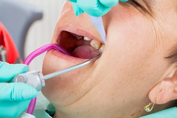 Senior Kobieta Fotelu Dentysty Usta Otworzyć Podczas Leczenia Stomatologicznego — Zdjęcie stockowe