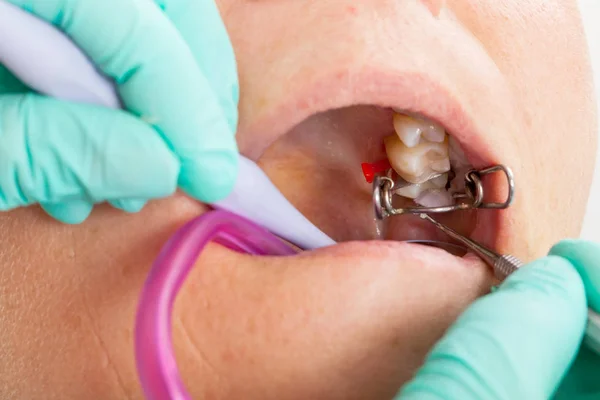 Femme Âgée Dans Chaise Dentiste Avec Bouche Ouverte Durring Traitement — Photo