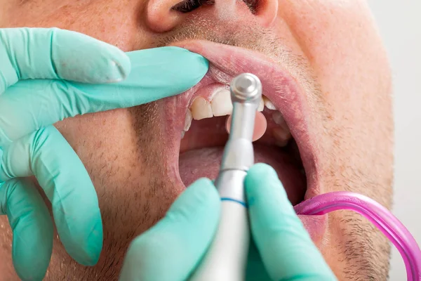 Fotoğrafı Bir Dişçi Diş Tedavisi Erkek Hastanın Ağız Boşluğu Matkap — Stok fotoğraf