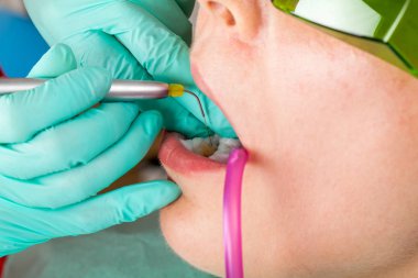 Oral tedavi için bir profesyonel diş lazer kullanarak diş hekimi
