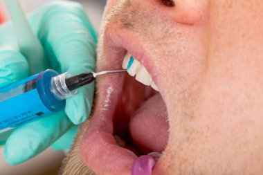 Adam açık bir diş dolgu elde