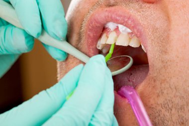 Adam açık bir diş dolgu elde