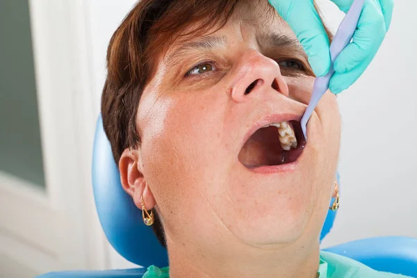 Femme Âgée Dans Chaise Dentiste Avec Bouche Ouverte Durring Traitement — Photo