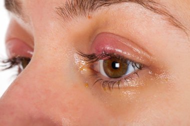 Üst göz kapağı iltihabı - chalazion - genç erkek viral enfeksiyon acı resmini kapatın