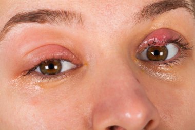 Üst göz kapağı iltihabı - chalazion - genç erkek viral enfeksiyon acı resmini kapatın