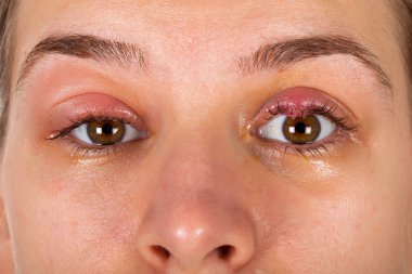 Üst göz kapağı iltihabı - chalazion - genç erkek viral enfeksiyon acı resmini kapatın