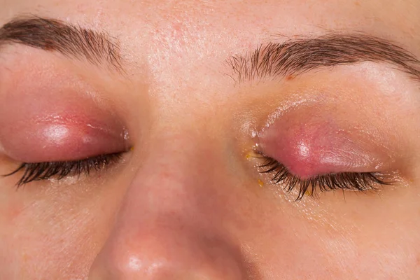 Nahaufnahme Einer Entzündung Des Oberen Augenlids Chalazion Junge Frau Mit — Stockfoto