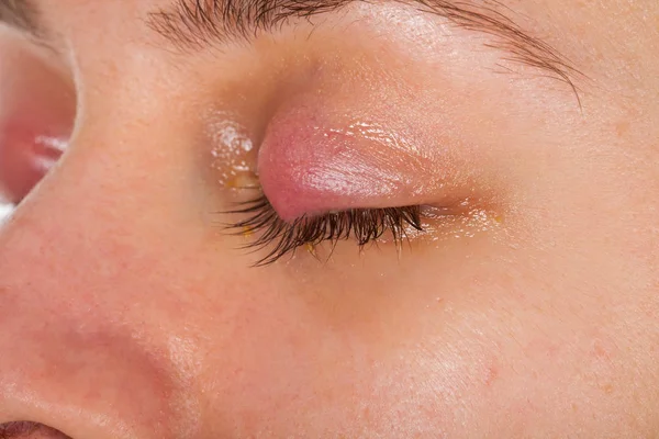 바이러스 으로부터 Chalazion 여자의 사진을 닫습니다 — 스톡 사진