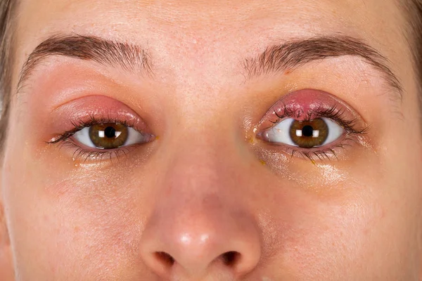Närbild Bild Övre Ögonlocket Inflammation Chalazionen Ung Kvinna Lider Virusinfektion — Stockfoto