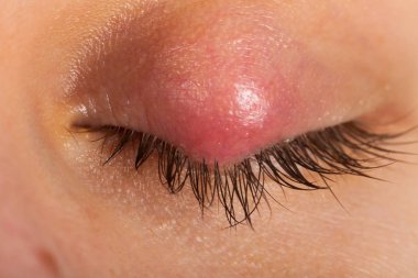 Kadın hastanın virüslü göz resmi oluşturan kapatın. Hordeolum üst göz kapağı üzerinde. Viral enfeksiyon. Stafilokok