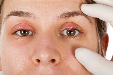 Kadın hasta göz enfeksiyonu. Hordeolum aseptik beyaz eldiven giyen doktor tarafından gösterilen üst göz kapağı üzerinde. Stafilokok