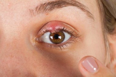 Close up picture of female patient's infected eye. Hordeolum on upper eyelid. Viral Infection. Staphylococcus clipart