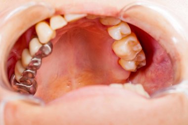 Close up picture of human cavity. Metal basis dental bridge clipart