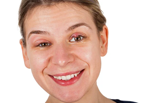 Lächelnde Frau Auf Isoliertem Hintergrund Mit Stye Staphylokokken Virusinfektion Oberlid — Stockfoto