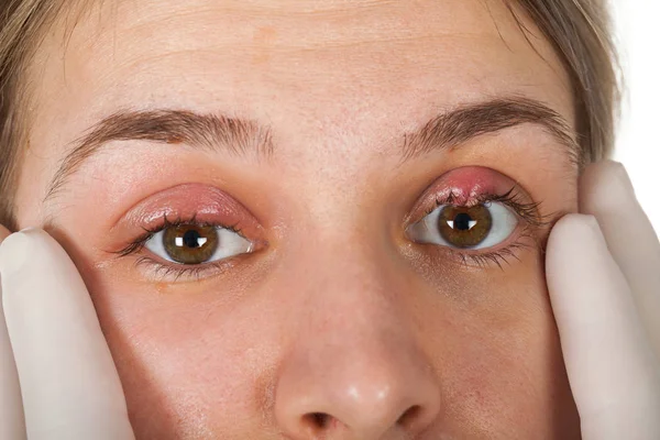 Närbild Bild Kvinnliga Patientens Infekterade Öga Hordeolum Övre Ögonlocket Virusinfektion — Stockfoto