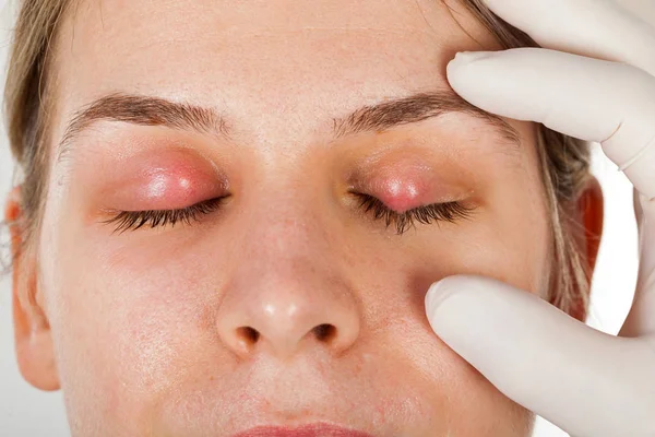 Γυναίκες Ασθενείς Οφθαλμική Λοίμωξη Κριθαράκι Στο Άνω Βλέφαρο Εμφανίζεται Γιατρός — Φωτογραφία Αρχείου