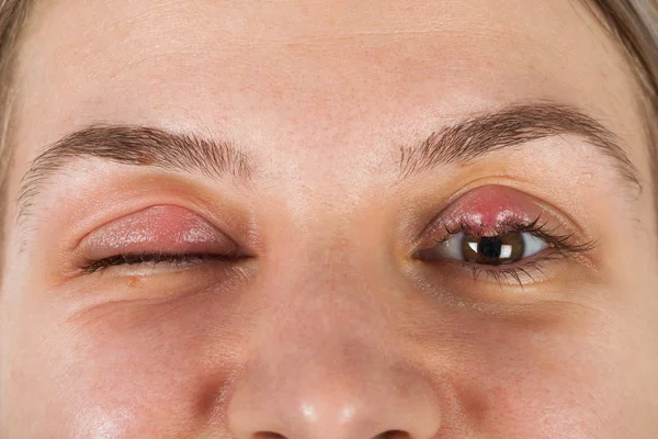 Kadın hastanın virüslü göz resmi oluşturan kapatın. Hordeolum üst göz kapağı üzerinde. Viral enfeksiyon. Stafilokok